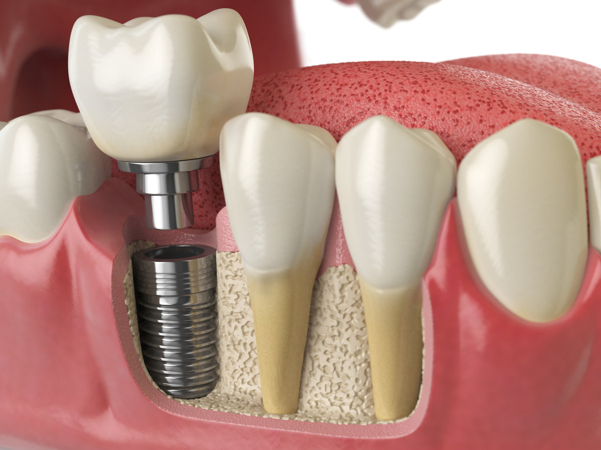 Single Tooth Implants vs. Bridges: Making the Right Choice in Oak Lawn