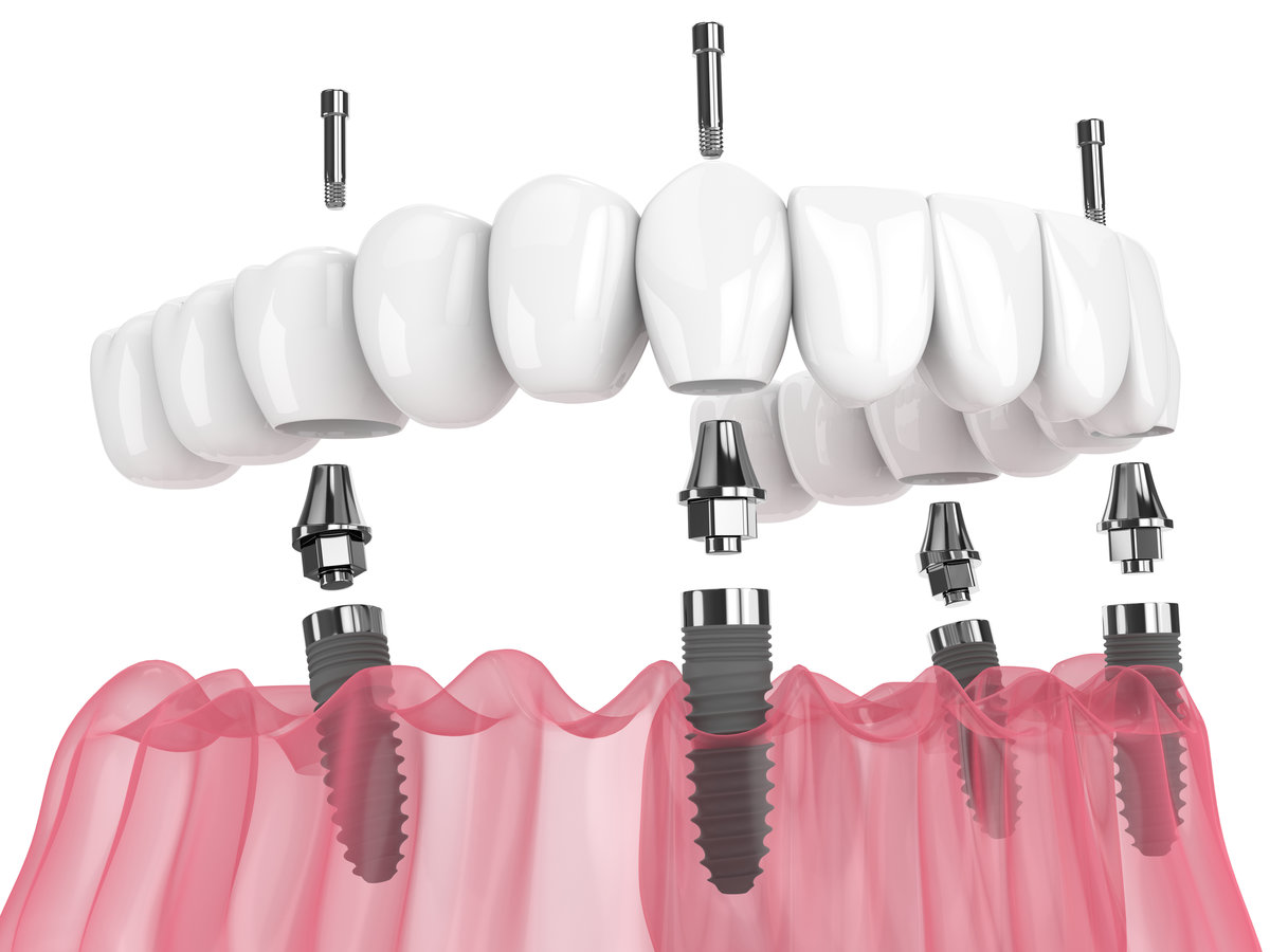 Recovery Timeline for All-on-X Dental Implants: A Week-by-Week Guide
