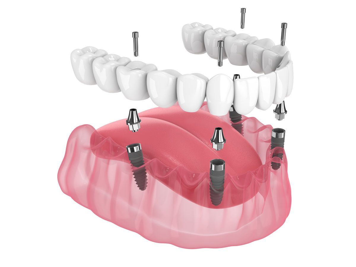 Same-Day Teeth Replacement: What to Expect from All-on-X Dental Implants