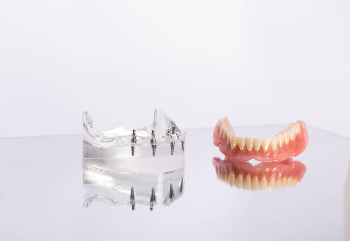 Caring for Your All-on-X Implants: Maintenance Tips for Long-Term Success